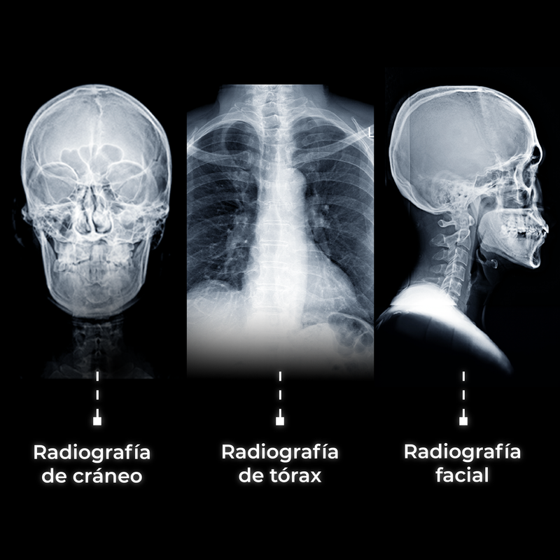 Equipo de rayos X portátil con batería recargable DRX3 - Marca SIUI